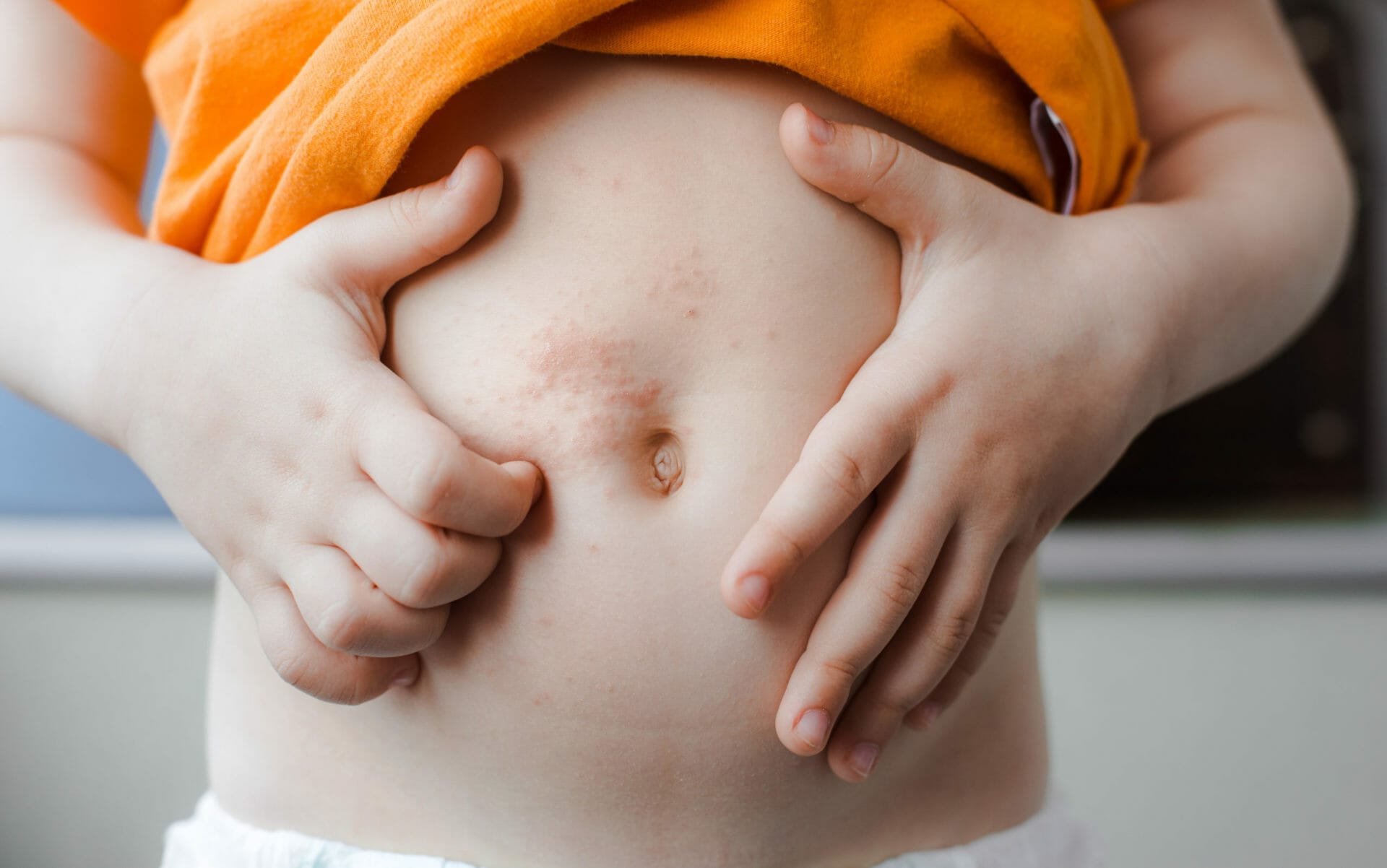 Chicken pox baby. The varicella zoster virus or scabies rash on the child. The concept of dermatology. Baby shows spots on his stomach. Close-up scratching. Allergy in children